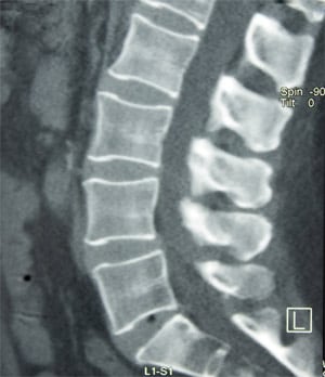 Spine Orange County Orthopedic Surgeons 2 - Spine