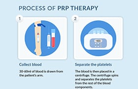 Process of PRP Therapy OC Orthopedic Surgeons thumb - Infographics